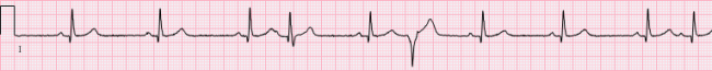 Rabbit Ear Sign ECG Guru Instructor Resources   ECG Of The Week 1y Supplimental 